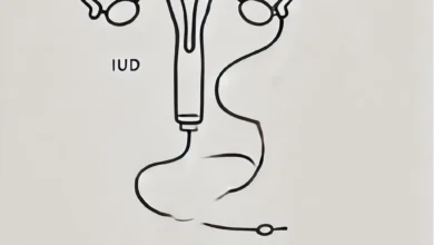 IUD Hormonal Tingkatkan Risiko Kanker Payudara